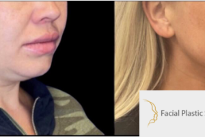 34-y.o-female-who-underwent-liposculpting-of-her-chin-and-neck-1
