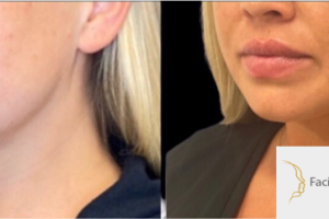 34-y.o-female-who-underwent-liposculpting-of-her-chin-and-neck-2