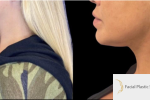 34-y.o-female-who-underwent-liposculpting-of-her-chin-and-neck-3