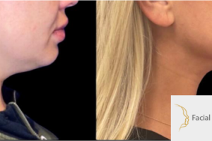 34-y.o-female-who-underwent-liposculpting-of-her-chin-and-neck-4