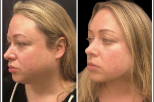 40-y.o-female-who-underwent-liposculpting-of-her-chin-and-neck-140-y.o-female-who-underwent-liposculpting-of-her-chin-and-neck-1