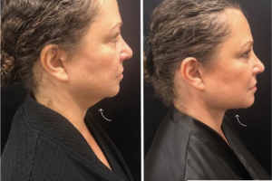 56-y.o-female-with-neck-laxity-who-desired-contouring-and-tightening-of-her-neck-1