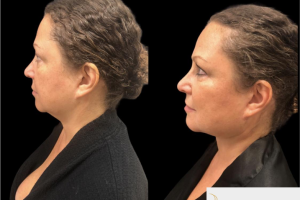 56-y.o-female-with-neck-laxity-who-desired-contouring-and-tightening-of-her-neck-2