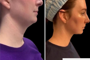 28-y.o-female-who-underwent-liposculpting-of-her-chin-and-neck-1