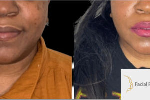 40-y.o-female-who-underwent-buccal-fat-reduction-liposculpting-of-her-chin-and-neck-1