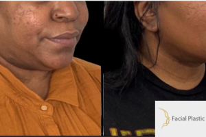 40-y.o-female-who-underwent-buccal-fat-reduction-liposculpting-of-her-chin-and-neck-2