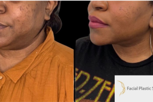 40-y.o-female-who-underwent-buccal-fat-reduction-liposculpting-of-her-chin-and-neck-3
