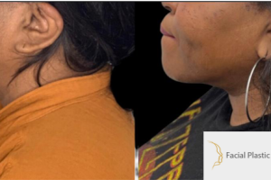 40-y.o-female-who-underwent-buccal-fat-reduction-liposculpting-of-her-chin-and-neck-4