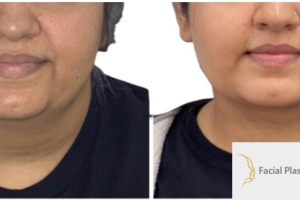 28-y.o-female-who-underwent-buccal-fat-reduction-liposculpting-of-her-chin-and-neck-1