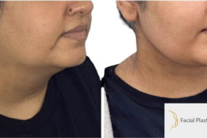 28-y.o-female-who-underwent-buccal-fat-reduction-liposculpting-of-her-chin-and-neck-2