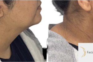 28-y.o-female-who-underwent-buccal-fat-reduction-liposculpting-of-her-chin-and-neck-3