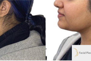 28-y.o-female-who-underwent-buccal-fat-reduction-liposculpting-of-her-chin-and-neck-4