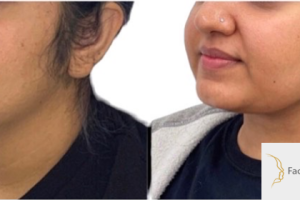 28-y.o-female-who-underwent-buccal-fat-reduction-liposculpting-of-her-chin-and-neck-5