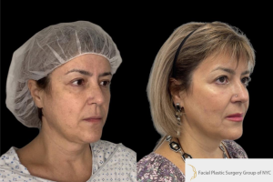 54-y.o-female-who-underwent-facial-fat-grafting-of-processed-nano-fat-to-cheeks-tear-trough-and-nasolabial-fold-1
