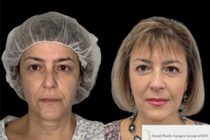 54-y.o-female-who-underwent-facial-fat-grafting-of-processed-nano-fat-to-cheeks-tear-trough-and-nasolabial-fold-2