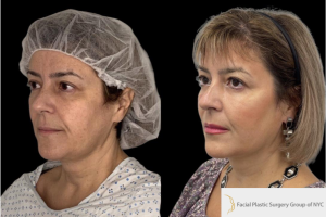 54-y.o-female-who-underwent-facial-fat-grafting-of-processed-nano-fat-to-cheeks-tear-trough-and-nasolabial-fold-3