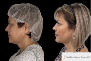 54-y.o-female-who-underwent-facial-fat-grafting-of-processed-nano-fat-to-cheeks-tear-trough-and-nasolabial-fold-4