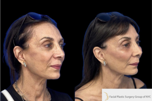 54-y.o-female-who-underwent-facial-fat-grafting-of-processed-nano-fat-to-cheeks-tear-trough-and-nasolabial-fold-1