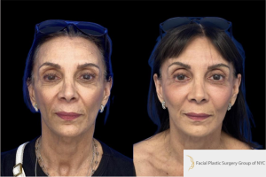54-y.o-female-who-underwent-facial-fat-grafting-of-processed-nano-fat-to-cheeks-tear-trough-and-nasolabial-fold-2