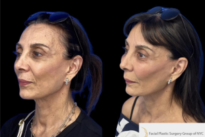 54-y.o-female-who-underwent-facial-fat-grafting-of-processed-nano-fat-to-cheeks-tear-trough-and-nasolabial-fold-3