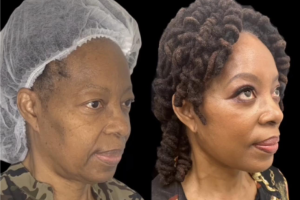 64-y.o-female-who-underwent-Deep-Plane-Facelift-Extended-Deep-plane-Neck-Lift-upper-blepharoplasty-1