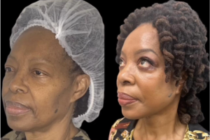 64-y.o-female-who-underwent-Deep-Plane-Facelift-Extended-Deep-plane-Neck-Lift-upper-blepharoplasty-3
