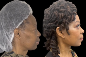 64-y.o-female-who-underwent-Deep-Plane-Facelift-Extended-Deep-plane-Neck-Lift-upper-blepharoplasty-4