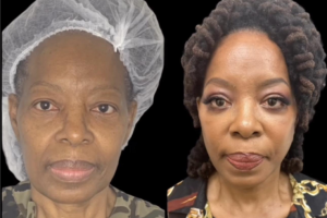 64-y.o-female-who-underwent-Deep-Plane-Facelift-Extended-Deep-plane-Neck-Lift-upper-blepharoplasty-5