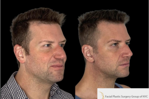 Extended-Deep-plane-Neck-Lift-1