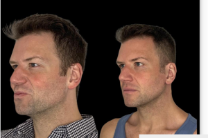 Extended-Deep-plane-Neck-Lift-2