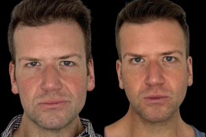 Extended-Deep-plane-Neck-Lift-3