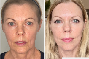49-yo-female-Deep-Plane-Facelift-1