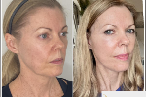 49-yo-female-Deep-Plane-Facelift-3