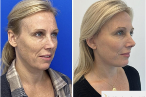 50-y.o-female-Deep-Plane-Facelift-1