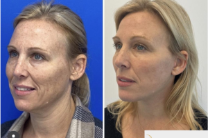 50-y.o-female-Deep-Plane-Facelift-2