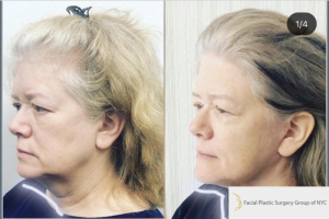 63-yo-female-High-SMAS-facelift-1