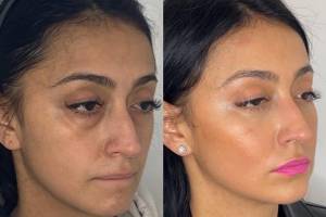 30-y.o-female-who-underwent-transconjuctival-lower-blepharoplasty-with-skin-pinch-and-facial-fat-transfer-2
