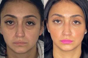 30-y.o-female-who-underwent-transconjuctival-lower-blepharoplasty-with-skin-pinch-and-facial-fat-transfer-3
