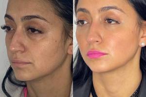 30-y.o-female-who-underwent-transconjuctival-lower-blepharoplasty-with-skin-pinch-and-facial-fat-transfer-4