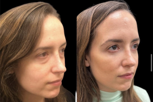 33-y.o-female-who-underwent-transconjuctival-lower-blepharoplasty-with-skin-pinch-and-facial-fat-transfer-1