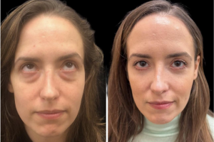 33-y.o-female-who-underwent-transconjuctival-lower-blepharoplasty-with-skin-pinch-and-facial-fat-transfer-2
