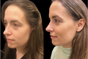 33-y.o-female-who-underwent-transconjuctival-lower-blepharoplasty-with-skin-pinch-and-facial-fat-transfer-3