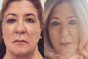 deep-plane-facelift-1