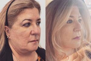 deep-plane-facelift-2