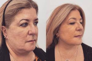 deep-plane-facelift-3
