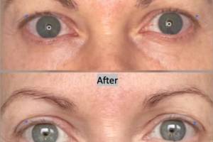 upper-blepharoplasty-1