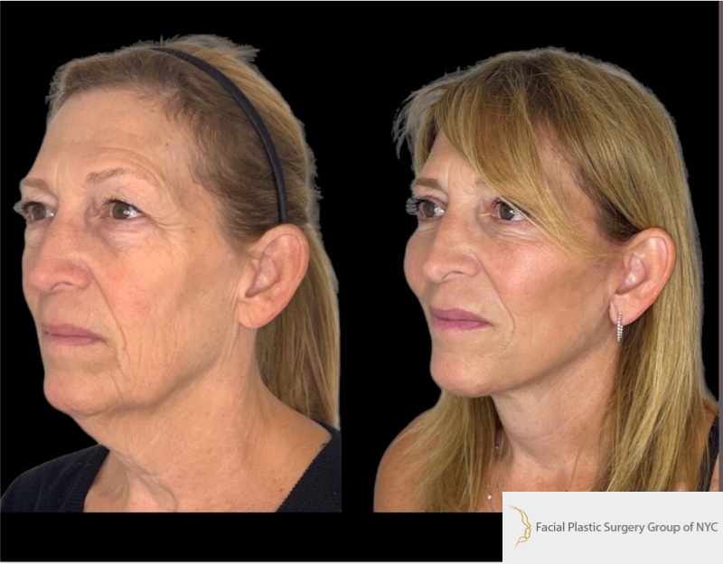 Best Deep Plane Facelift Plastic Surgeon NYC