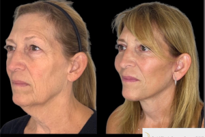 60-y.o-female-who-underwent-Deep-Plane-Facelift-Extended-Deep-plane-Neck-Lift-Upper-Blepharoplasty-Lower-Blepharoplasty-Facial-Fat-Transfer-and-CO2-laser-1