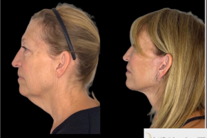 60-y.o-female-who-underwent-Deep-Plane-Facelift-Extended-Deep-plane-Neck-Lift-Upper-Blepharoplasty-Lower-Blepharoplasty-Facial-Fat-Transfer-and-CO2-laser-2