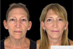 60-y.o-female-who-underwent-Deep-Plane-Facelift-Extended-Deep-plane-Neck-Lift-Upper-Blepharoplasty-Lower-Blepharoplasty-Facial-Fat-Transfer-and-CO2-laser-3